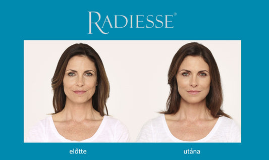 Radiesse with lidocaine